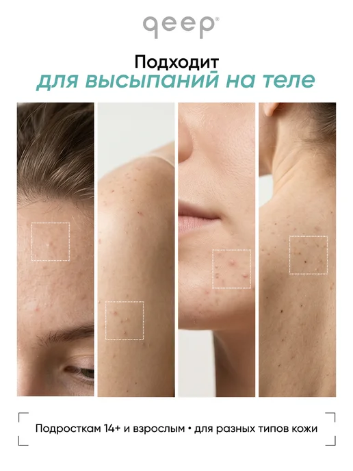 QEEP Крем корректор точечный против прыщей, вариант, фото 4