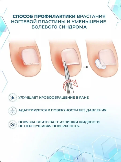 FreshNails Набор для коррекции вросших ногтей Лигазано 50х200мм, 50x200 мм, фото 3