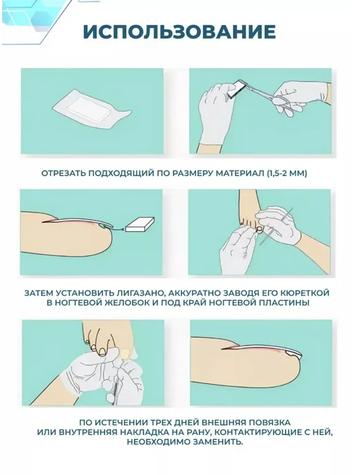 FreshNails Набор для коррекции вросших ногтей Лигазано 50х200мм, 50x200 мм, фото 5